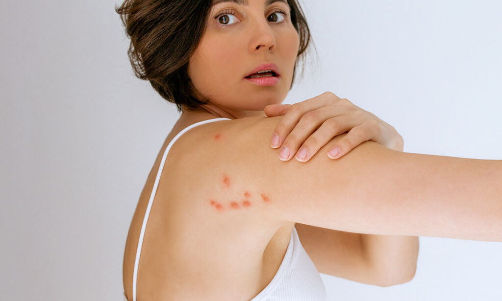 photo of a woman bit by baby bed bugs