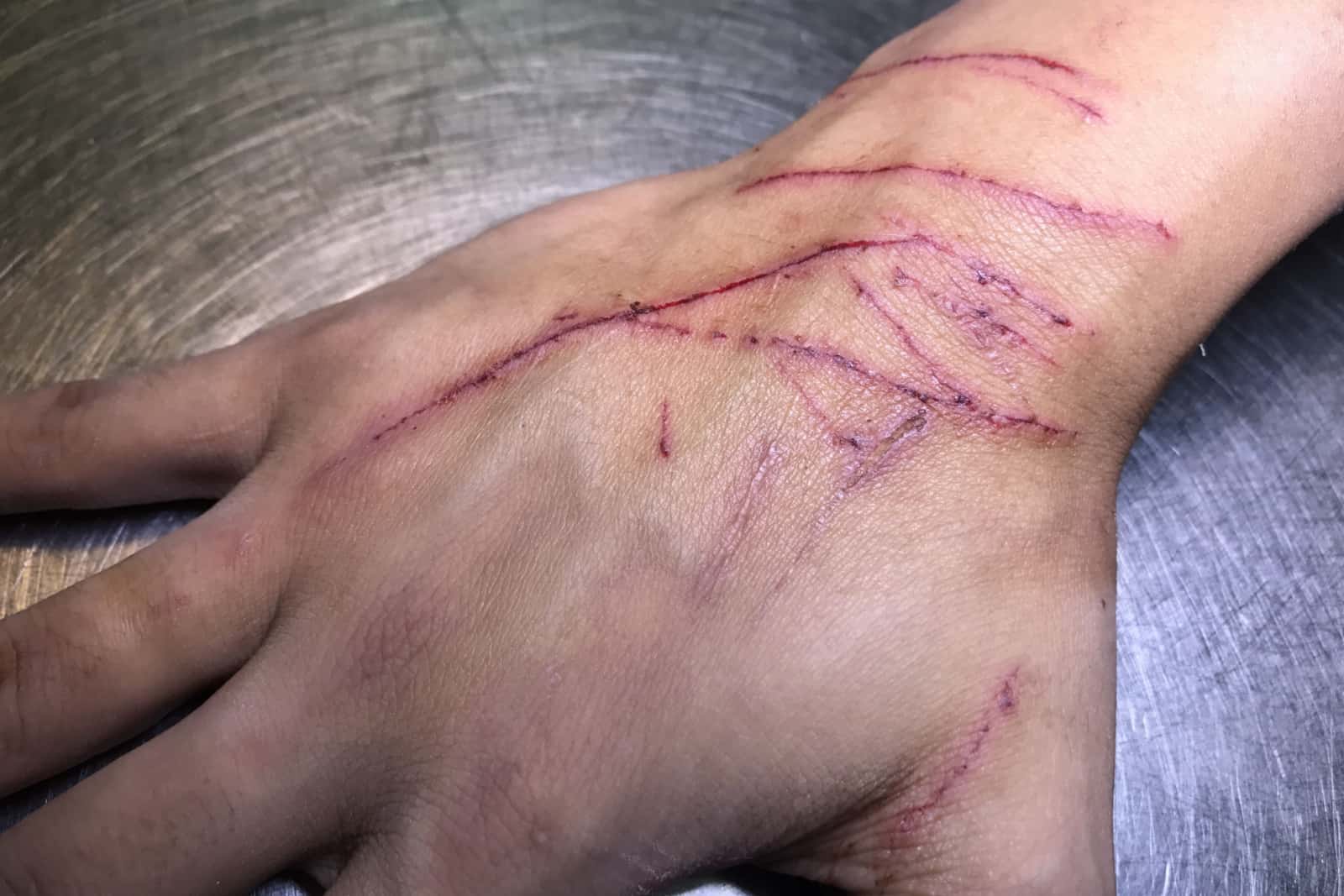 The skin condition after cat scratch and bite of veterinary surgeon hand during physical examination in a veterinary clinic